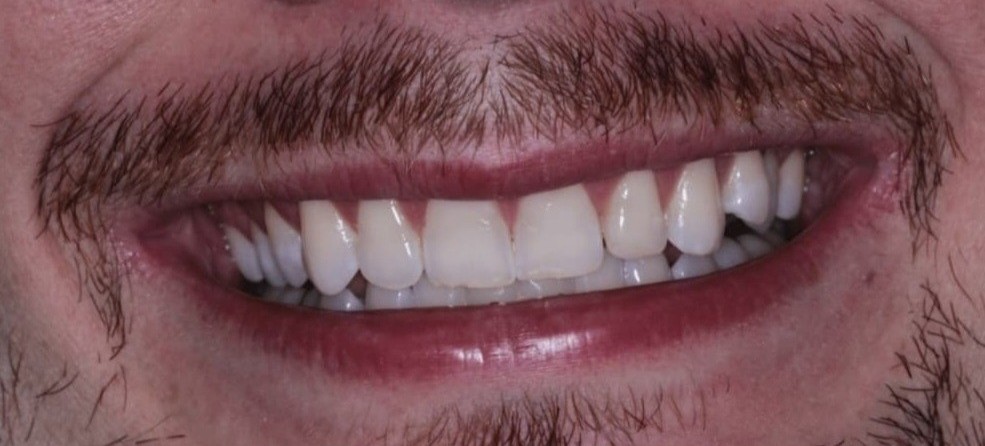 Sorriso com dentes escurecidos antes do tratamento