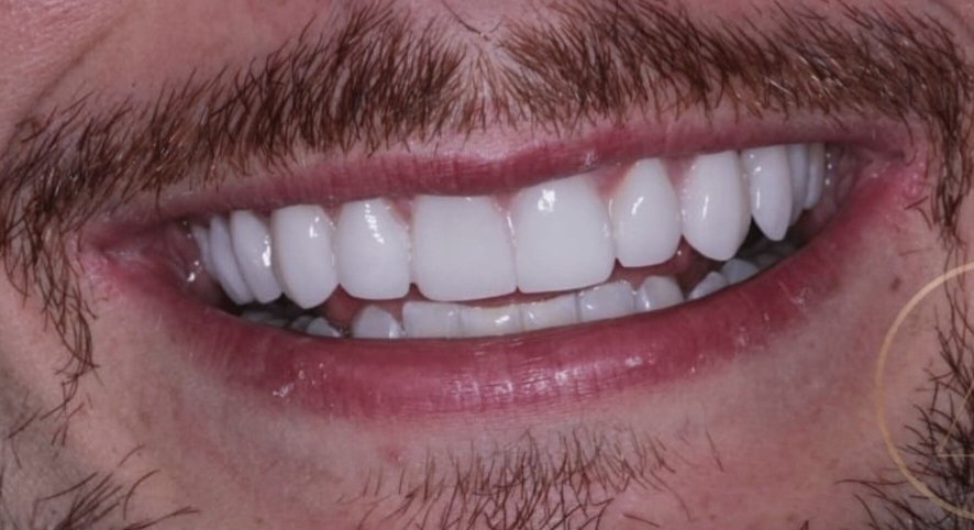 Sorriso claro e uniforme após o tratamento