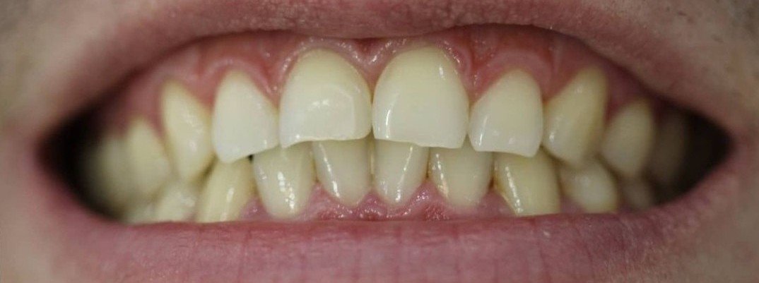 Sorriso de perfil com desalinhamento antes do tratamento
