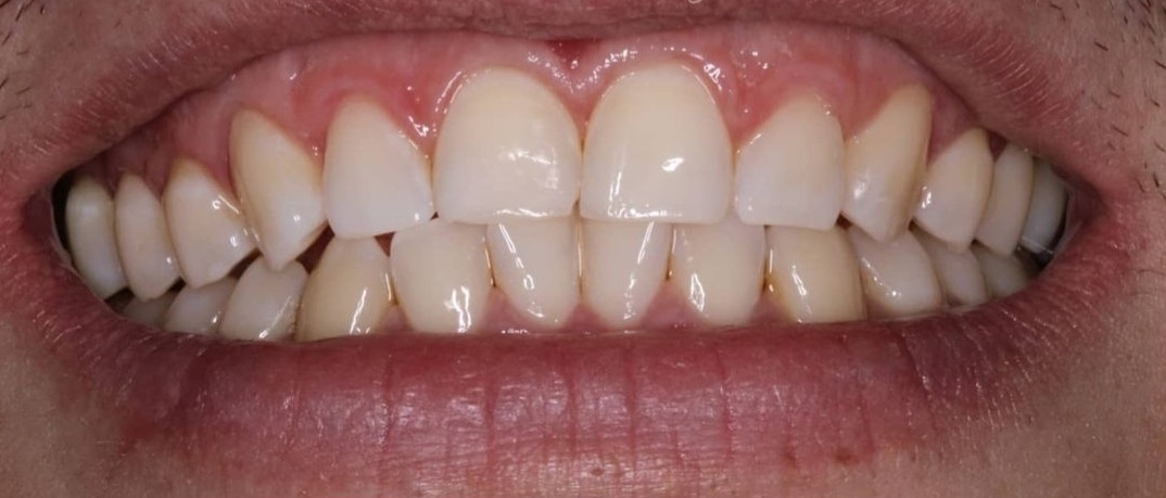 Sorriso de perfil alinhado após o tratamento