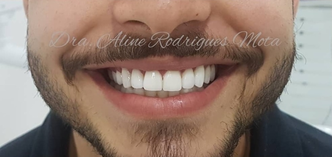 Lentes de contato dental