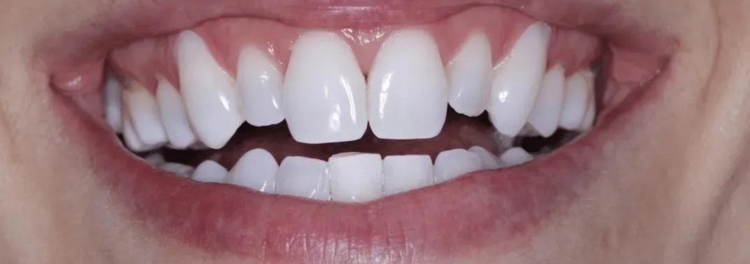 Clareamento dental